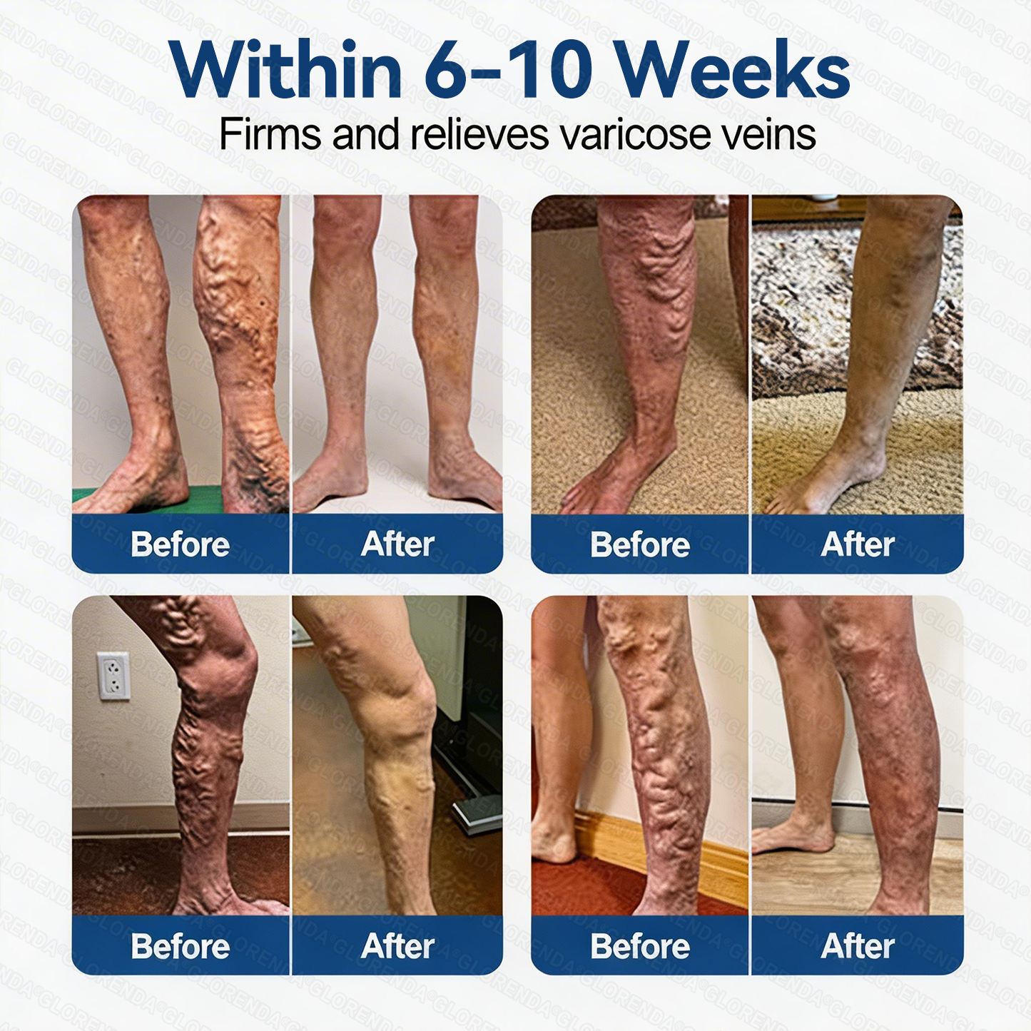 👨‍⚕️🛡️𝐆𝑳𝑶𝗥𝙀𝙉𝐃𝑨® 𝑽𝗲𝗶𝙣 𝘾𝐨𝐧𝘁𝗼𝙪𝙧 𝙈𝙞𝐜𝐫𝒐𝒏𝒆𝗲𝗱𝗹𝙚 𝙋𝙖𝐭𝐜𝒉 𝒘𝒊𝘁𝗵 𝗔𝙙𝙫𝙖𝙣𝙘𝐞𝐝 𝐃𝒊𝒐𝒔𝗺𝙞𝐧 & 𝑯𝒆𝘀𝗽𝗲𝙧𝙞𝙙𝙞𝐧 𝐃𝒆𝒍𝒊𝒗𝗲𝗿𝙮🌿𝟕-𝐃𝐚𝐲 𝐕𝐢𝐬𝐢𝐛𝐥𝐞 𝐑𝐞𝐬𝐮𝐥𝐭𝐬 𝐟𝐨𝐫 𝐕𝐚𝐫𝐢𝐜𝐨𝐬𝐞 𝐕𝐞𝐢𝐧𝐬 — 𝗔𝗱𝘃𝗮𝗻𝗰𝗲𝗱 𝗛𝗲𝗿𝗯𝗮𝗹 𝗕𝗹𝗲𝗻𝗱 𝗧𝗮𝗿𝗴𝗲𝘁𝘀 𝗦𝗽𝗶𝗱𝗲𝗿 𝗩𝗲𝗶𝗻𝘀 & 𝗥𝗲𝗹𝗶𝗲𝘃𝗲𝘀 𝗛𝗲𝗮𝘃𝘆, 𝗧𝗶𝗿𝗲𝗱 𝗟𝗲𝗴𝘀