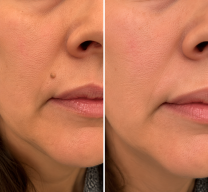 ✨✨𝐏𝑬𝗔𝙍𝙇𝐌𝑶𝗢𝙉®2-in-1 Microneedle & Hydrocolloid Patch🍀| Removes Raised Moles, Acne, Flat Warts & Skin Tags | Helps Improve Wrinkles, Scars & Blemishes | Invisible Patches for Face & Body