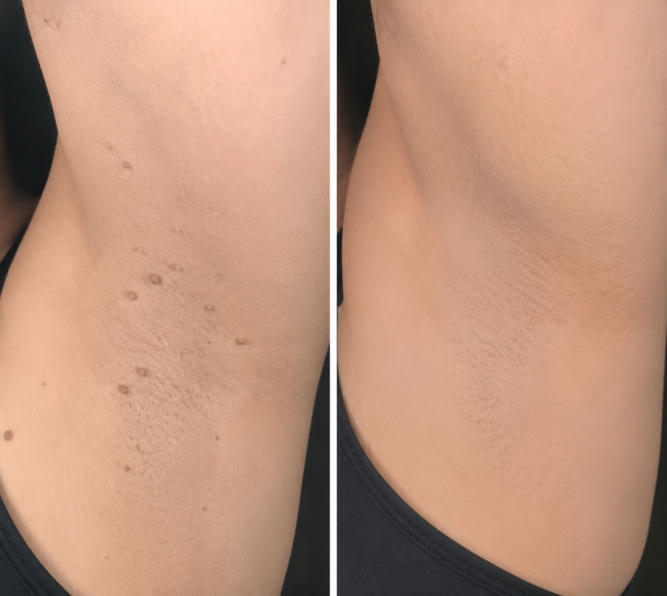 ✨✨𝐏𝑬𝗔𝙍𝙇𝐌𝑶𝗢𝙉®2-in-1 Microneedle & Hydrocolloid Patch🍀| Removes Raised Moles, Acne, Flat Warts & Skin Tags | Helps Improve Wrinkles, Scars & Blemishes | Invisible Patches for Face & Body