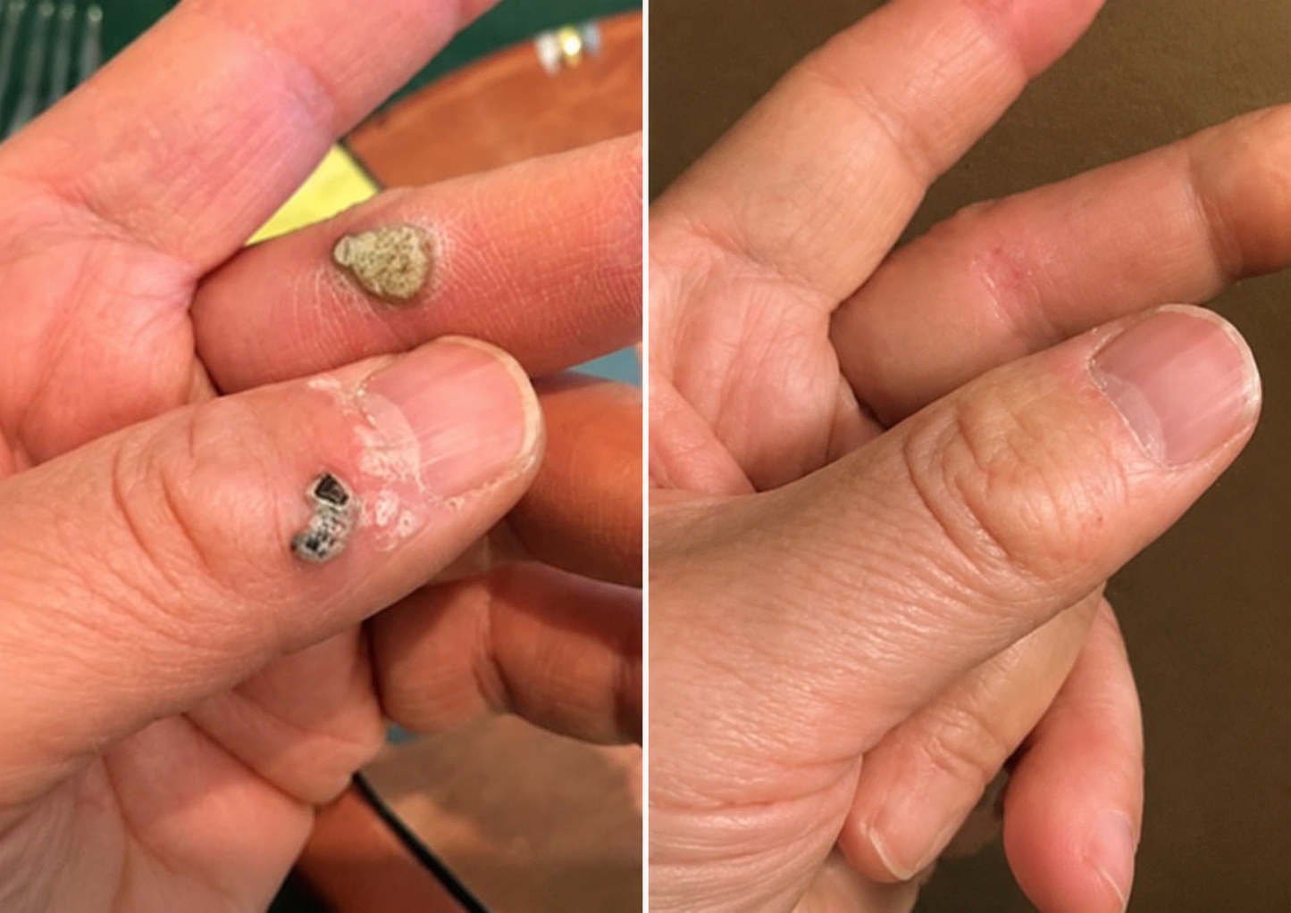 ✨✨𝐏𝑬𝗔𝙍𝙇𝐌𝑶𝗢𝙉®2-in-1 Microneedle & Hydrocolloid Patch🍀| Removes Raised Moles, Acne, Flat Warts & Skin Tags | Helps Improve Wrinkles, Scars & Blemishes | Invisible Patches for Face & Body