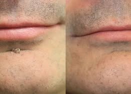 ✨✨𝐏𝑬𝗔𝙍𝙇𝐌𝑶𝗢𝙉®2-in-1 Microneedle & Hydrocolloid Patch🍀| Removes Raised Moles, Acne, Flat Warts & Skin Tags | Helps Improve Wrinkles, Scars & Blemishes | Invisible Patches for Face & Body
