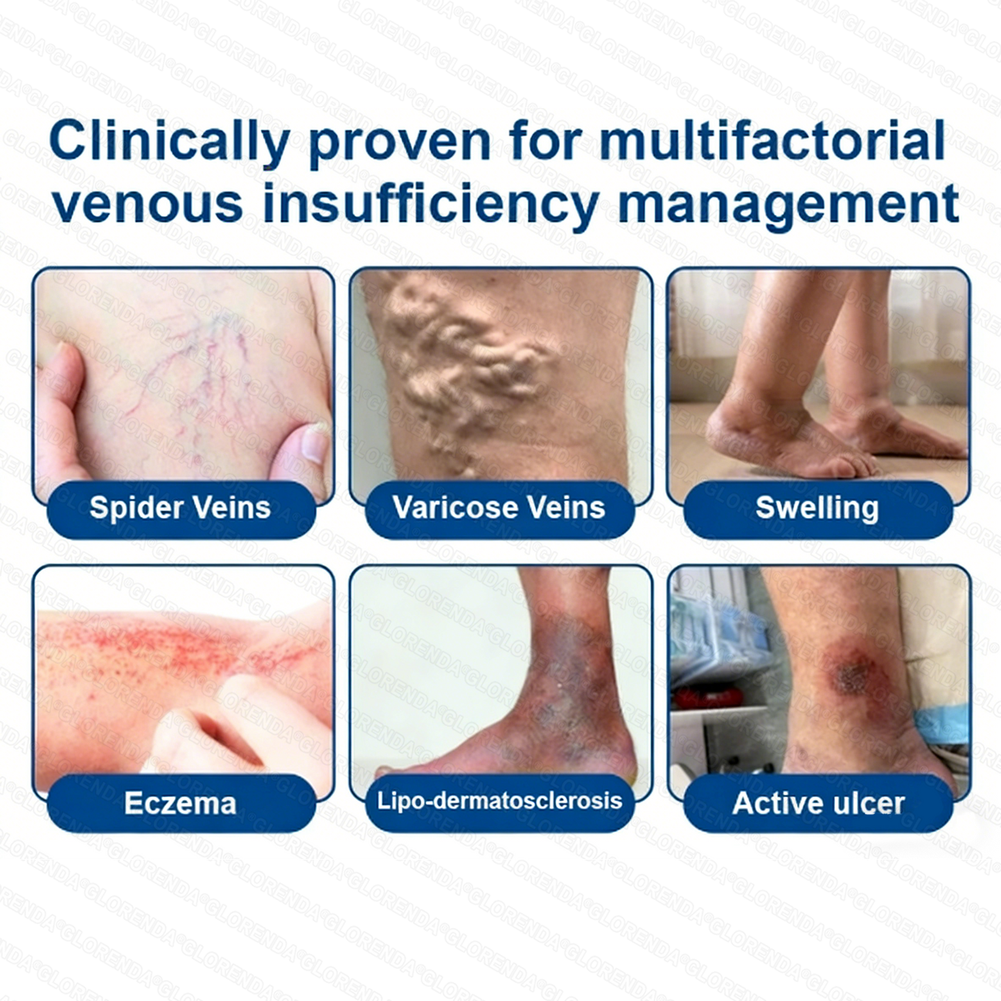 👨‍⚕️🛡️𝐆𝑳𝑶𝗥𝙀𝙉𝐃𝑨® 𝑽𝗲𝗶𝙣 𝘾𝐨𝐧𝘁𝗼𝙪𝙧 𝙈𝙞𝐜𝐫𝒐𝒏𝒆𝗲𝗱𝗹𝙚 𝙋𝙖𝐭𝐜𝒉 𝒘𝒊𝘁𝗵 𝗔𝙙𝙫𝙖𝙣𝙘𝐞𝐝 𝐃𝒊𝒐𝒔𝗺𝙞𝐧 & 𝑯𝒆𝘀𝗽𝗲𝙧𝙞𝙙𝙞𝐧 𝐃𝒆𝒍𝒊𝒗𝗲𝗿𝙮🌿𝟕-𝐃𝐚𝐲 𝐕𝐢𝐬𝐢𝐛𝐥𝐞 𝐑𝐞𝐬𝐮𝐥𝐭𝐬 𝐟𝐨𝐫 𝐕𝐚𝐫𝐢𝐜𝐨𝐬𝐞 𝐕𝐞𝐢𝐧𝐬 — 𝗔𝗱𝘃𝗮𝗻𝗰𝗲𝗱 𝗛𝗲𝗿𝗯𝗮𝗹 𝗕𝗹𝗲𝗻𝗱 𝗧𝗮𝗿𝗴𝗲𝘁𝘀 𝗦𝗽𝗶𝗱𝗲𝗿 𝗩𝗲𝗶𝗻𝘀 & 𝗥𝗲𝗹𝗶𝗲𝘃𝗲𝘀 𝗛𝗲𝗮𝘃𝘆, 𝗧𝗶𝗿𝗲𝗱 𝗟𝗲𝗴𝘀